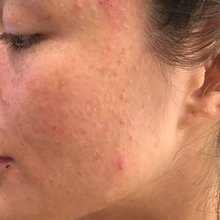 Woman's cheek with skin blemishes